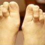 Молоткообразные палецы стопы